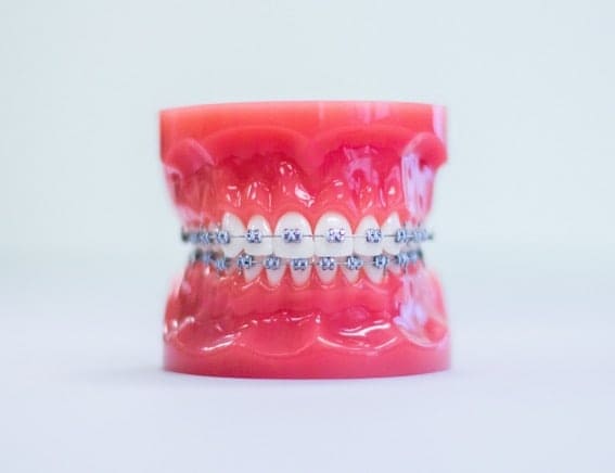 modern braces
